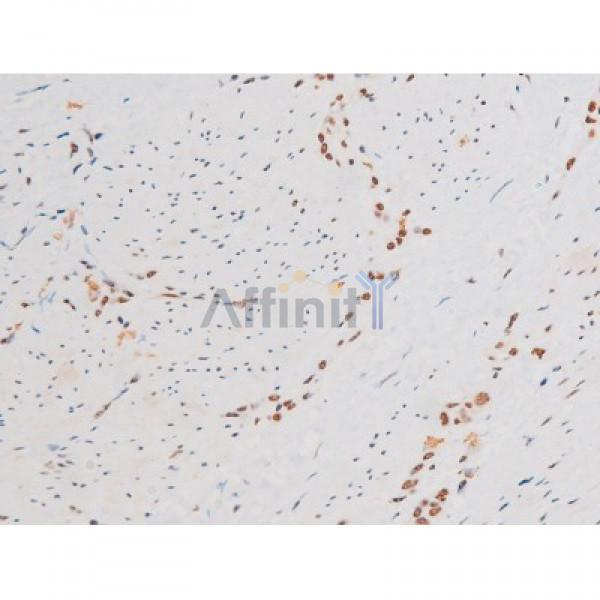 Phospho-NF-kB p65 (Ser281) Antibody - AF3393 at 1/200 staining Human bladder cancer tissue sections by IHC-P.